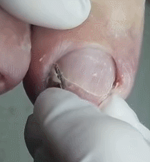쾌감 오지는 내성발톱 제거 움짤ㄷㄷㄷㄷㄷㄷ. gif (혐오주의) | 인스티즈