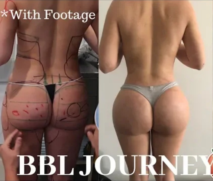 외국에서 유행하는 뒤태 성형수술,, | 인스티즈