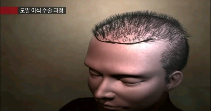 실제 모발이식 수술 장면.jpg (사진주의) | 인스티즈