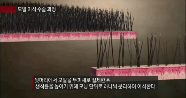 실제 모발이식 수술 장면.jpg (사진주의) | 인스티즈