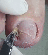 쾌감 오지는 내성발톱 제거 움짤ㄷㄷㄷㄷㄷㄷ. gif (혐오주의) | 인스티즈
