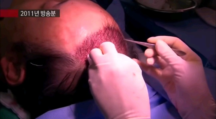 실제 모발이식 수술 장면.jpg (사진주의) | 인스티즈