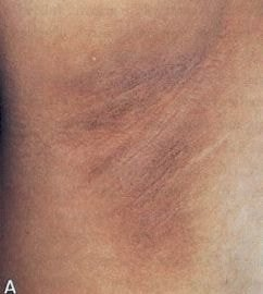 99%가 땟자국이라고 생각했던 목 뒤 '검은 튼 살'의 소름끼치는 정체 | 인스티즈