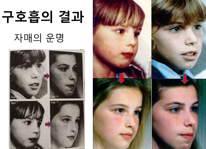 어릴 때 입으로 호흡한 결과.... | 인스티즈
