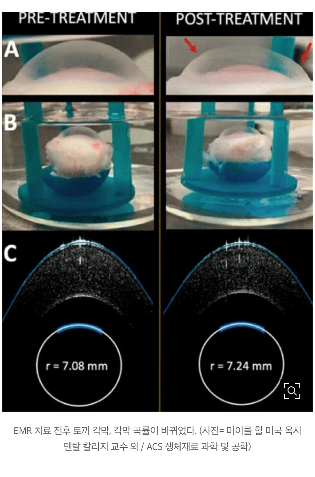 "라식수술 필요 없다"…1분 만에 시력 교정하는 기술 나왔다 | 인스티즈
