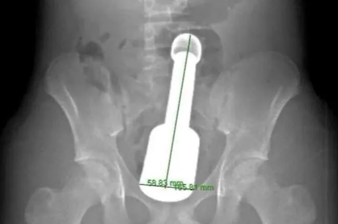 18cm 절구공이 항문에 박혀 입원한 베트남 15세 소년 | 인스티즈