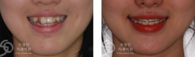 치아교정 하는 중 혹은 치아교정 하고 난 뒤 종종 꾸는 꿈 | 인스티즈