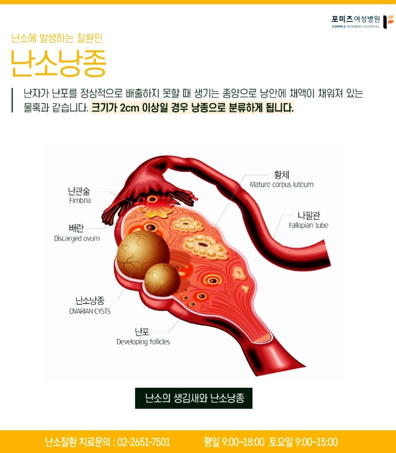 나 아니야..?싶은 난소낭종 증상 | 인스티즈