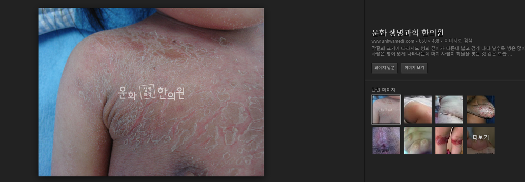 아토피 피부염이 비염과 비교되면 안되는 이유 (혐오주의) | 인스티즈
