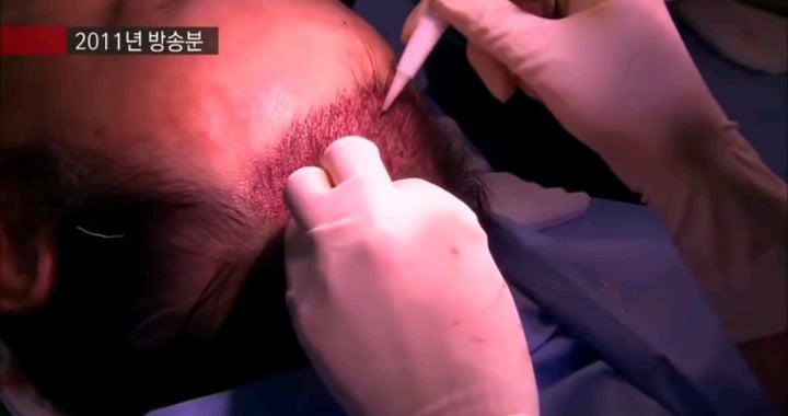 실제 모발이식 수술 장면.jpg (사진주의) | 인스티즈
