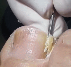 쾌감 오지는 내성발톱 제거 움짤ㄷㄷㄷㄷㄷㄷ. gif (혐오주의) | 인스티즈