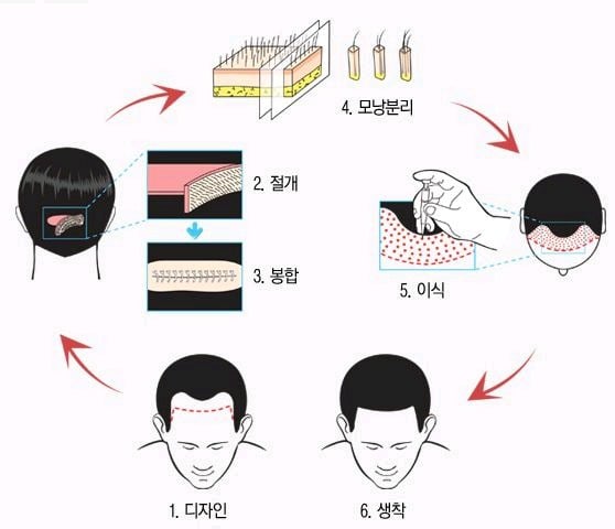 실제 모발이식 수술 장면.jpg (사진주의) | 인스티즈