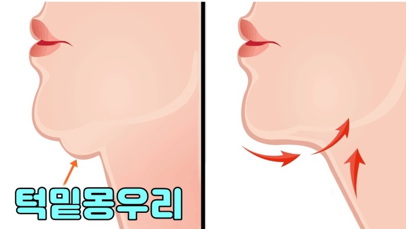 사각턱 보톡스 부작용 알려줌 | 인스티즈