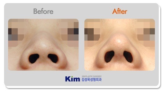 코성형중에서 필러 다음으로 인기가 많은 수술 | 인스티즈