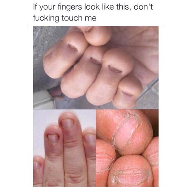 손톱물어뜯는 버릇의 최후 | 인스티즈