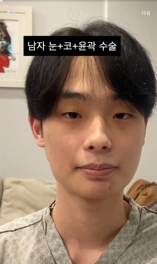 남자 성형 전후 눈+코+윤곽 | 인스티즈