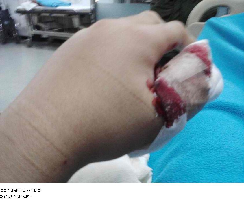 뱀에 물리면 빨리 병원 가야하는 이유 | 인스티즈