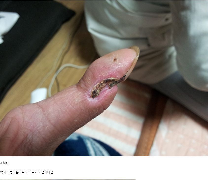 뱀에 물리면 빨리 병원 가야하는 이유 | 인스티즈