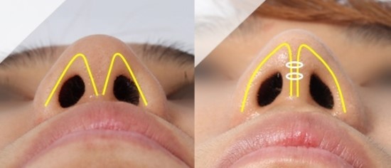 코성형중에서 필러 다음으로 인기가 많은 수술 | 인스티즈