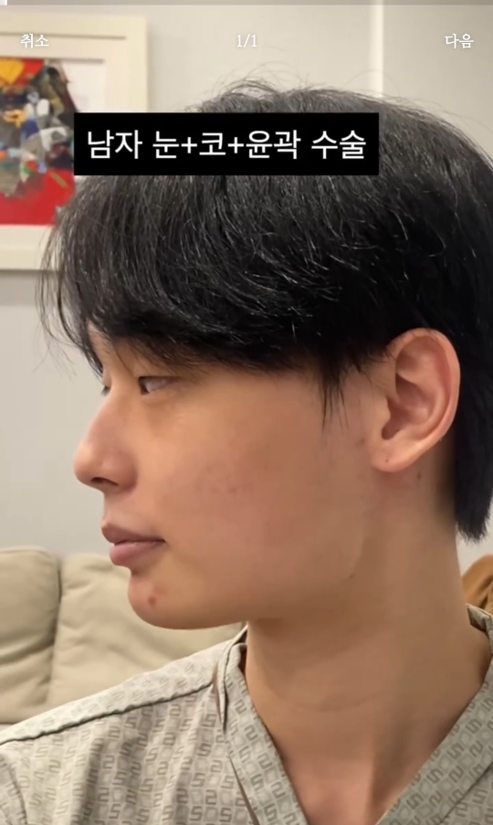 남자 성형 전후 눈+코+윤곽 | 인스티즈