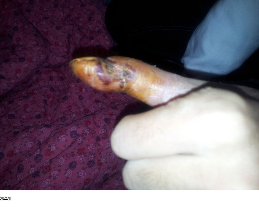 뱀에 물리면 빨리 병원 가야하는 이유 | 인스티즈