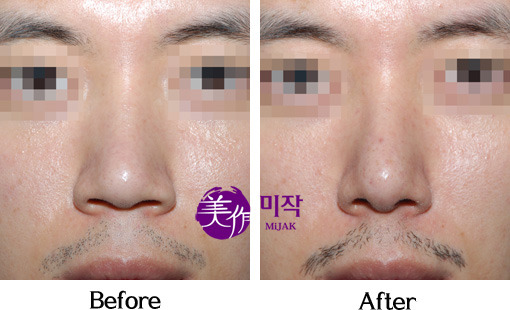 코성형중에서 필러 다음으로 인기가 많은 수술 | 인스티즈