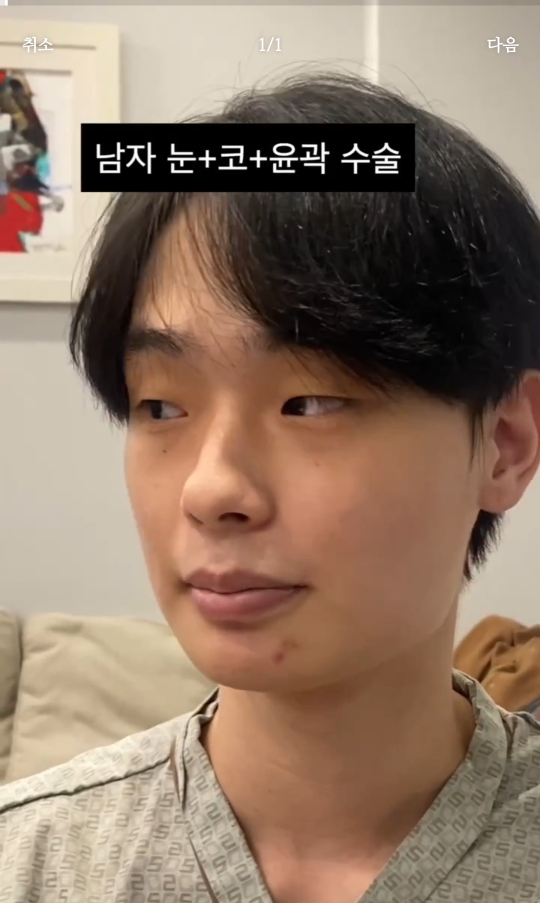 남자 성형 전후 눈+코+윤곽 | 인스티즈