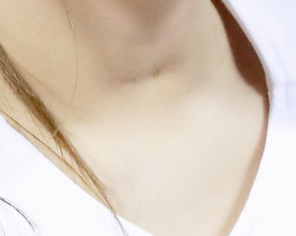 목에 수술 흉터 있는 최예나 | 인스티즈