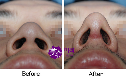 코성형중에서 필러 다음으로 인기가 많은 수술 | 인스티즈