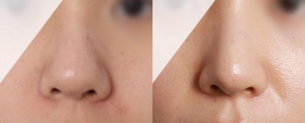 코성형중에서 필러 다음으로 인기가 많은 수술 | 인스티즈