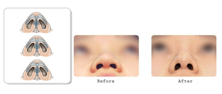 코성형중에서 필러 다음으로 인기가 많은 수술 | 인스티즈