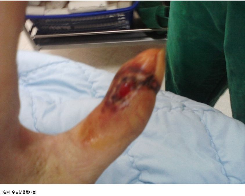 뱀에 물리면 빨리 병원 가야하는 이유 | 인스티즈