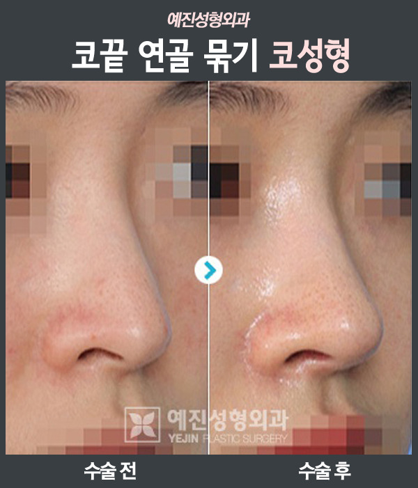 코성형중에서 필러 다음으로 인기가 많은 수술 | 인스티즈