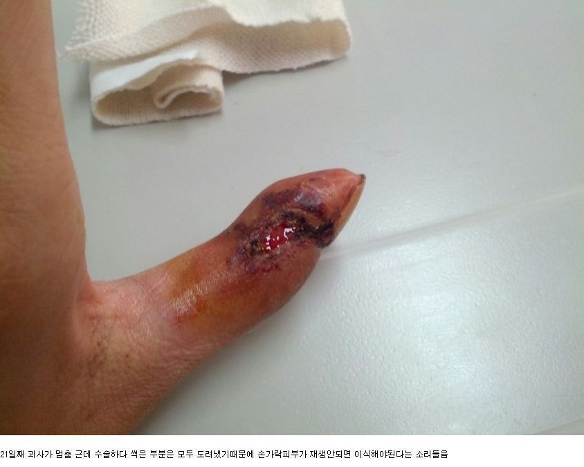 뱀에 물리면 빨리 병원 가야하는 이유 | 인스티즈