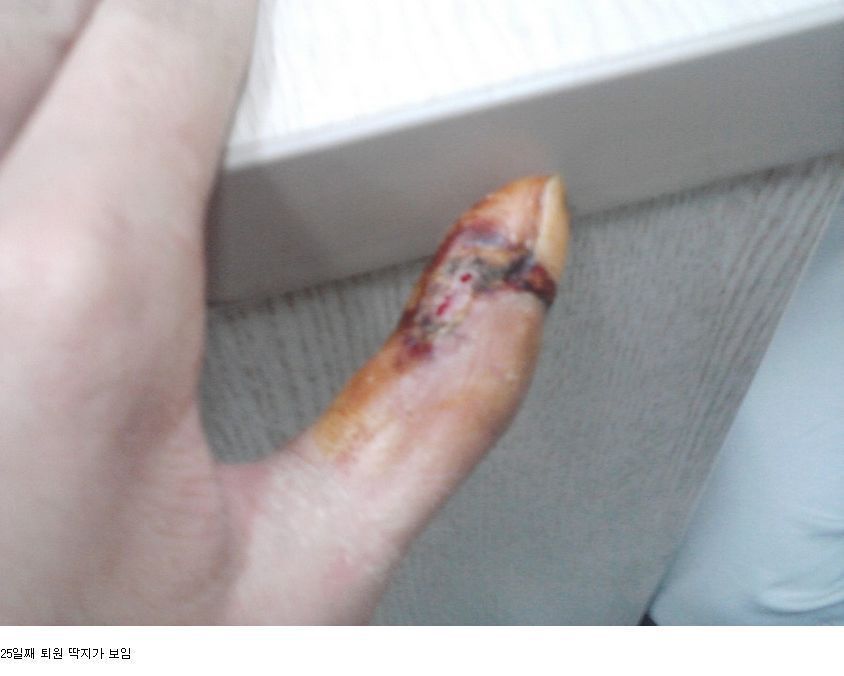 뱀에 물리면 빨리 병원 가야하는 이유 | 인스티즈