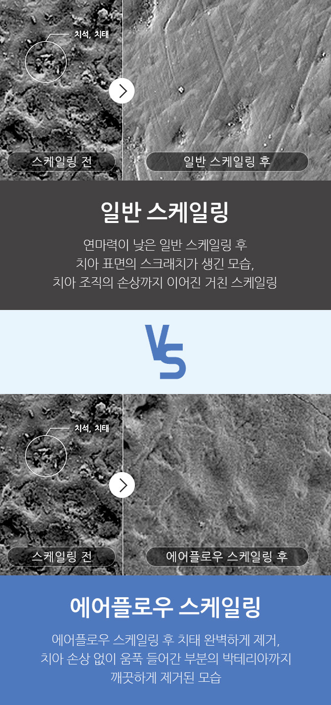 요즘 좋아졌다는 치과 스케일링 기술 | 인스티즈