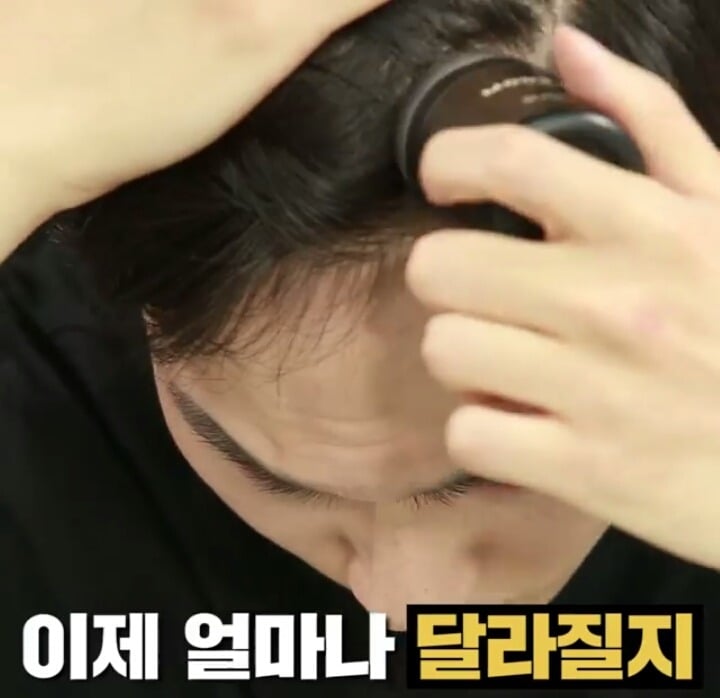 M자탈모 희소식 | 인스티즈