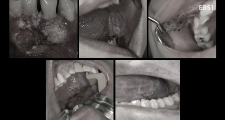 구강암 환자들은 혀를 잘라야한다는 사실에 큰 심리적 충격을 받는다.jpg | 인스티즈