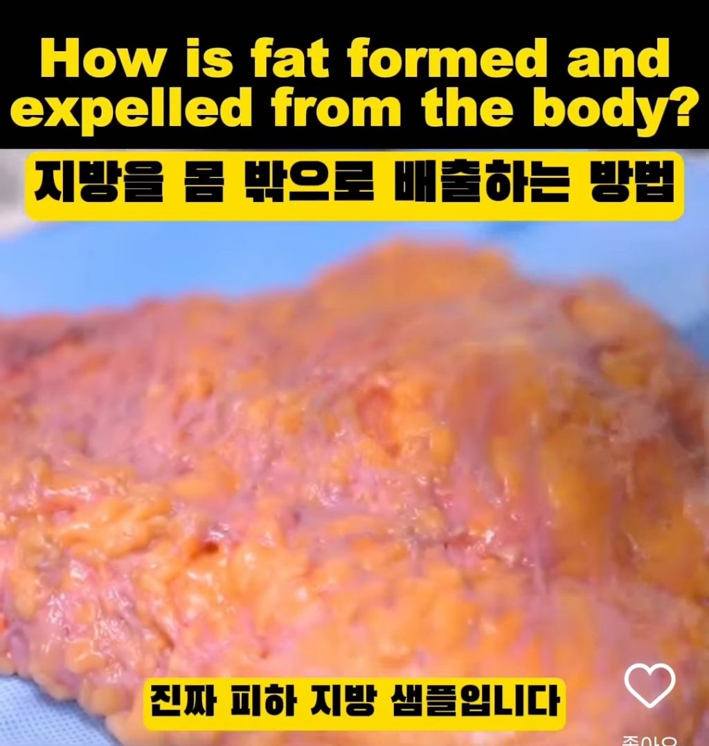 실제 피하지방 모습 | 인스티즈