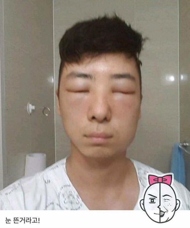 염색약 부작용 ㅎㄷㄷ(혐오주의) | 인스티즈