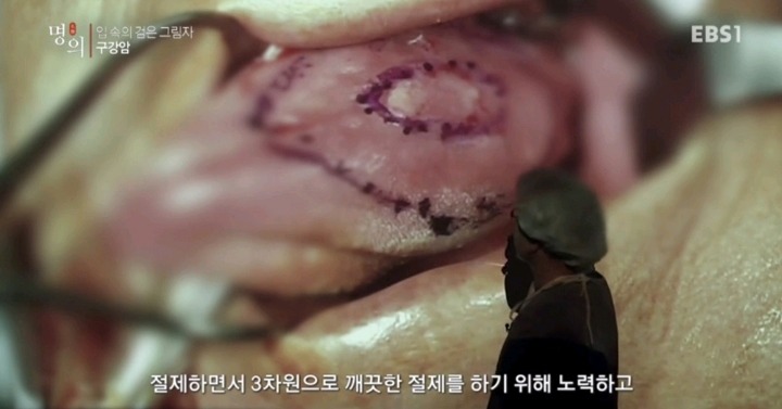 구강암 환자들은 혀를 잘라야한다는 사실에 큰 심리적 충격을 받는다.jpg | 인스티즈