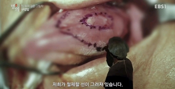 구강암 환자들은 혀를 잘라야한다는 사실에 큰 심리적 충격을 받는다.jpg | 인스티즈