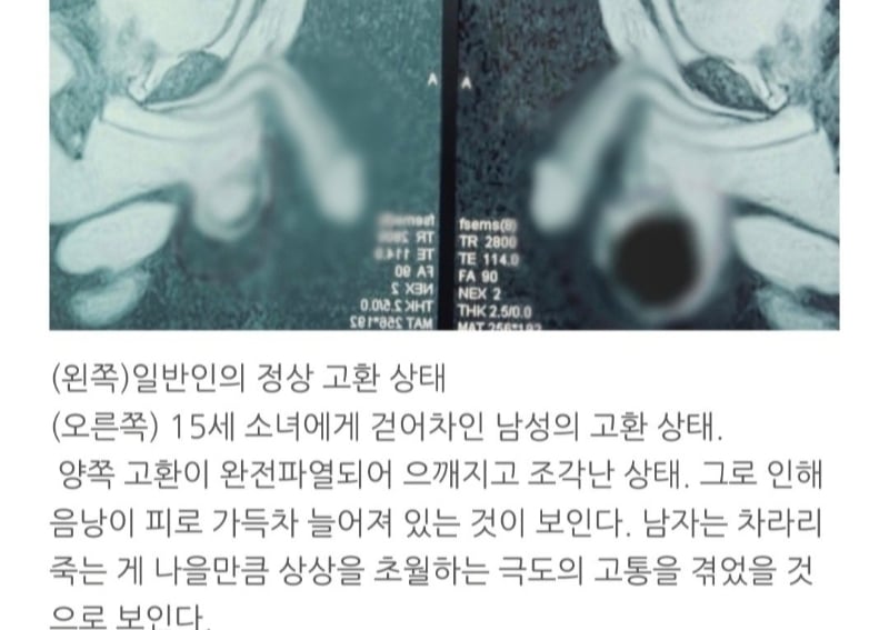 발레를 배워야 하는 이유 (고환 파열) | 인스티즈