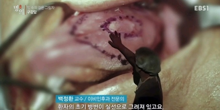 구강암 환자들은 혀를 잘라야한다는 사실에 큰 심리적 충격을 받는다.jpg | 인스티즈
