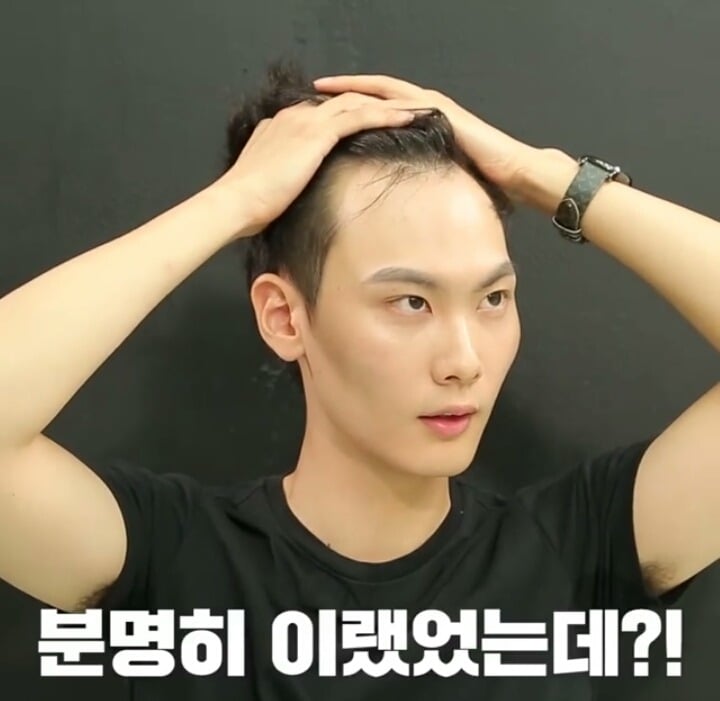 M자탈모 희소식 | 인스티즈