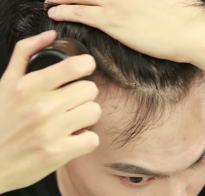 M자탈모 희소식 | 인스티즈
