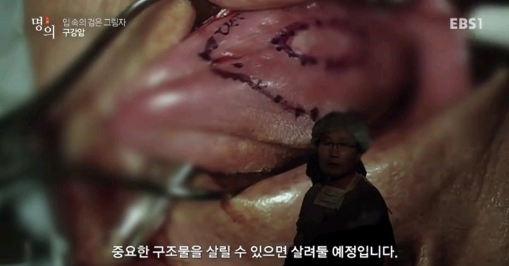구강암 환자들은 혀를 잘라야한다는 사실에 큰 심리적 충격을 받는다.jpg | 인스티즈