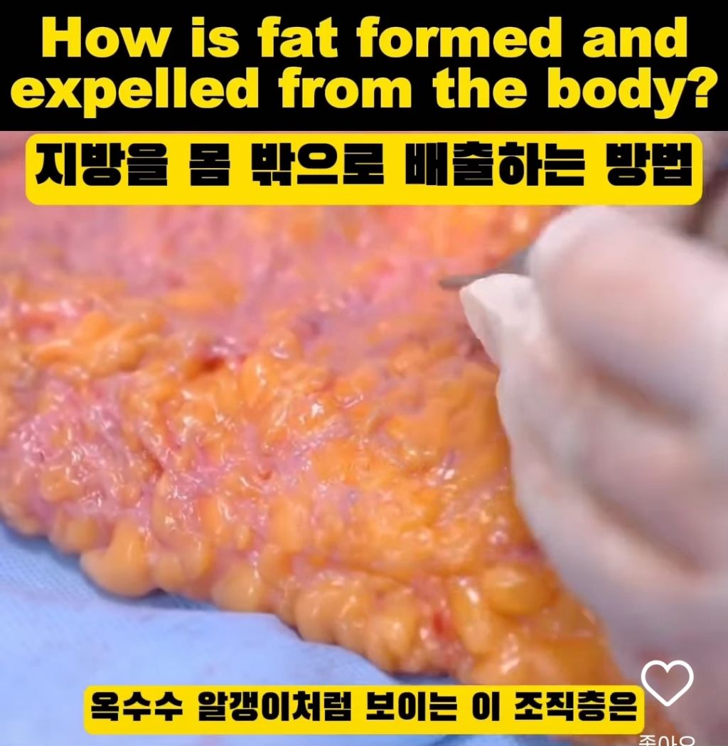 실제 피하지방 모습 | 인스티즈