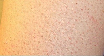 의외로 많은 사람들이 가지고 있는 피부병.jpg | 인스티즈