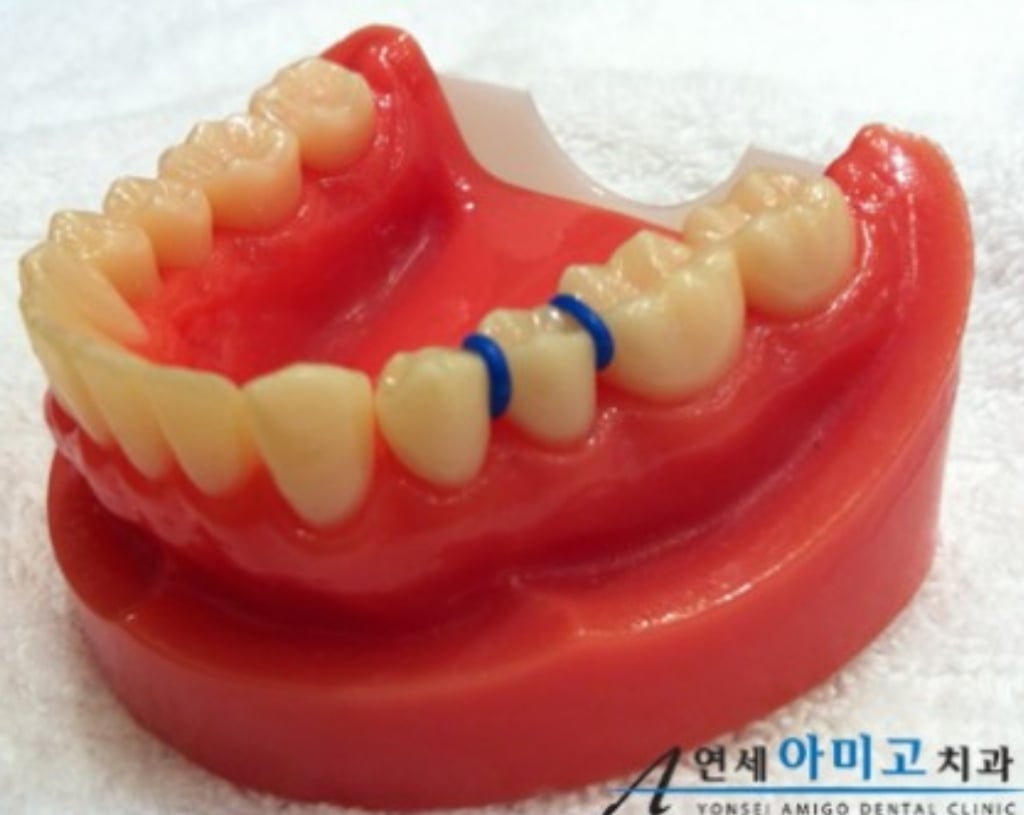 치아교정 극악의 고통류 甲 | 인스티즈